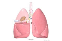 What to Expect After Lung Cancer Surgery