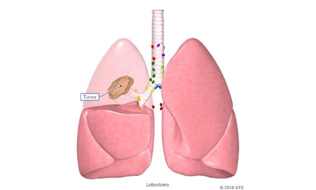 What to Expect After Lung Cancer Surgery