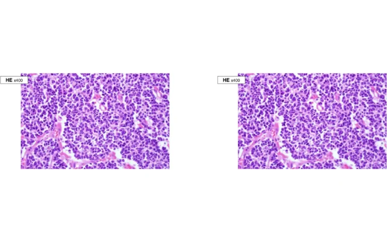 Death from Neuroendocrine Cancer