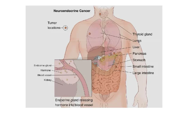 How Bad is Neuroendocrine Cancer