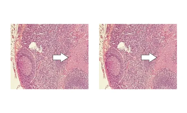 Large Cell Neuroendocrine Cancer