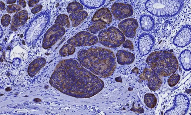 Neuroendocrine Cancer ICD 10