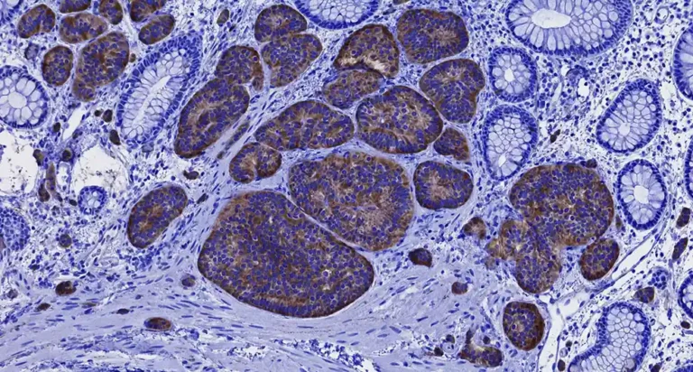 Neuroendocrine Cancer ICD 10