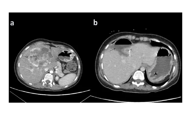 Neuroendocrine Cancer Liver