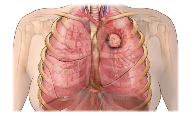 Neuroendocrine Carcinoid Lung Cancer