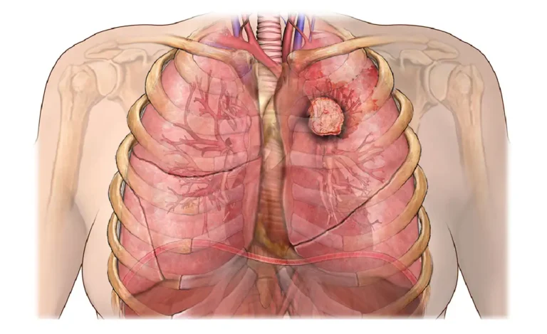 Neuroendocrine Carcinoid Lung Cancer