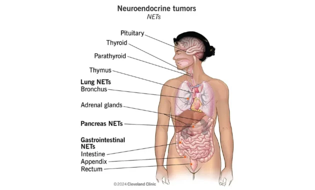 Neuroendocrine Carcinoma Cancer