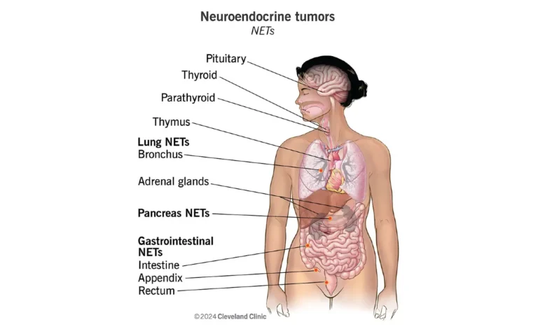 Neuroendocrine Carcinoma Cancer