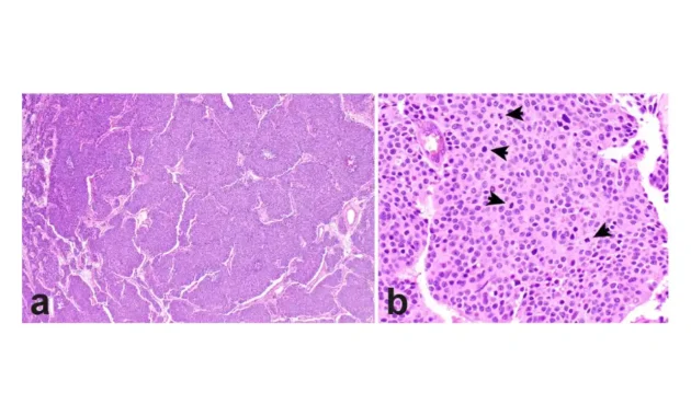 Neuroendocrine Lung Cancer