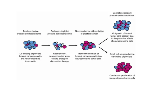 Neuroendocrine Prostate Cancer