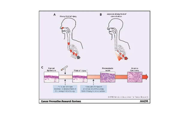 Pathogenesis of Lung Cancer