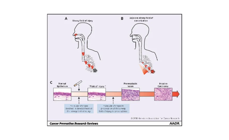Pathogenesis of Lung Cancer