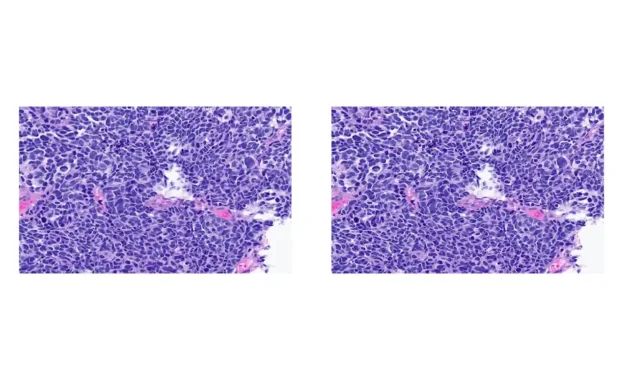 Small Cell Neuroendocrine Cancer