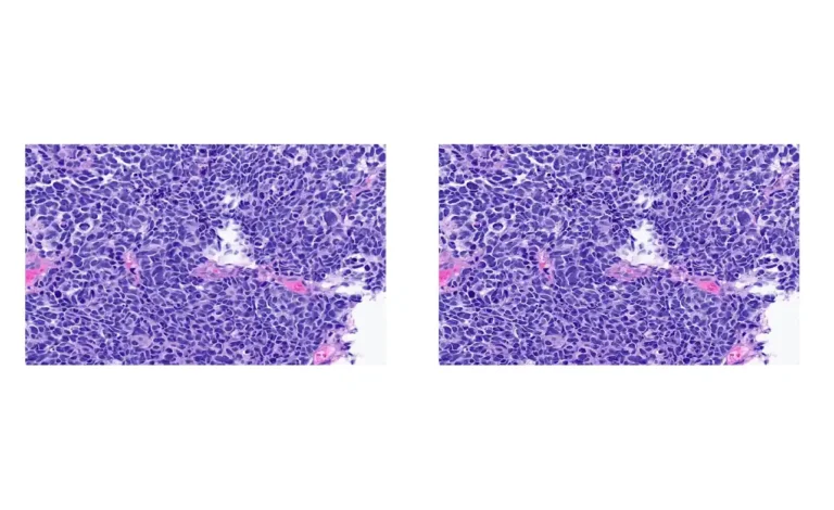 Small Cell Neuroendocrine Cancer