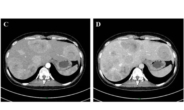 Stage 4 Neuroendocrine Cancer Spread to Liver Life Expectancy