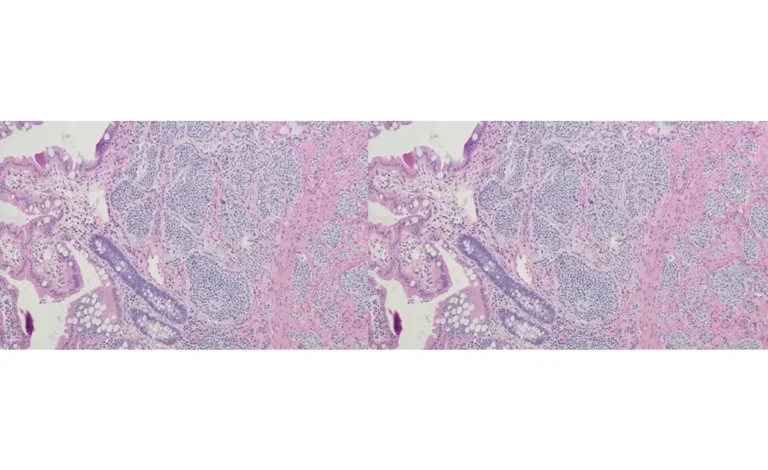 neuroendocrine carcinoid cancer