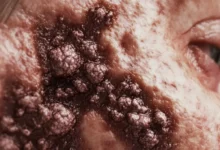 What Does Skin Cancer Look Like
