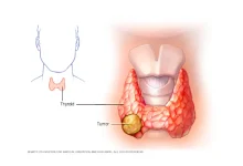 Thyroid Cancer Lump on Neck