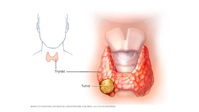 Thyroid Cancer Lump on Neck