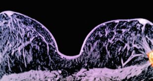 Breast Shrinking Cancer