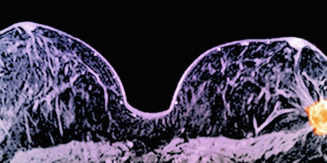 Breast Shrinking Cancer