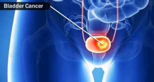 New Treatments for Bladder Cancer