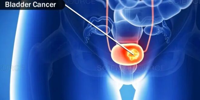 New Treatments for Bladder Cancer